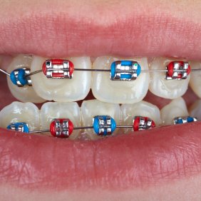 Smart Braces